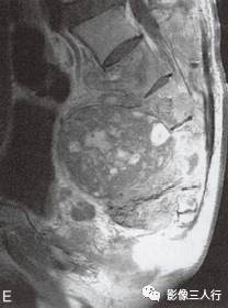 【病例】腰骶段脊索瘤1例MR影像分析