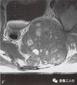 【病例】腰骶段脊索瘤1例MR影像分析