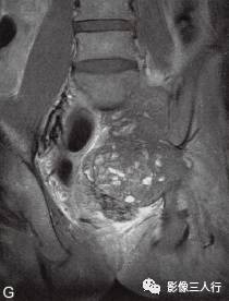 【病例】腰骶段脊索瘤1例MR影像分析