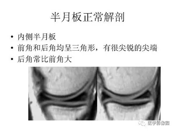【PPT】半月板的影像学表现