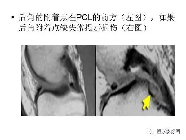 【PPT】半月板的影像学表现