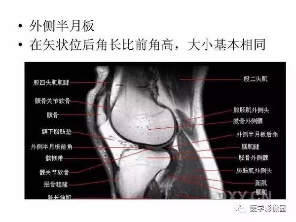 【PPT】半月板的影像学表现