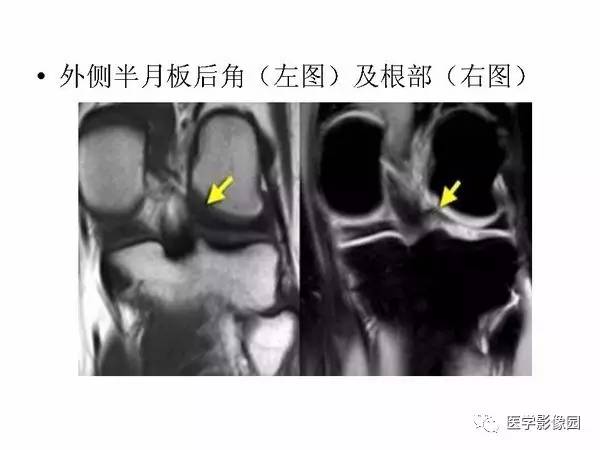 【PPT】半月板的影像学表现