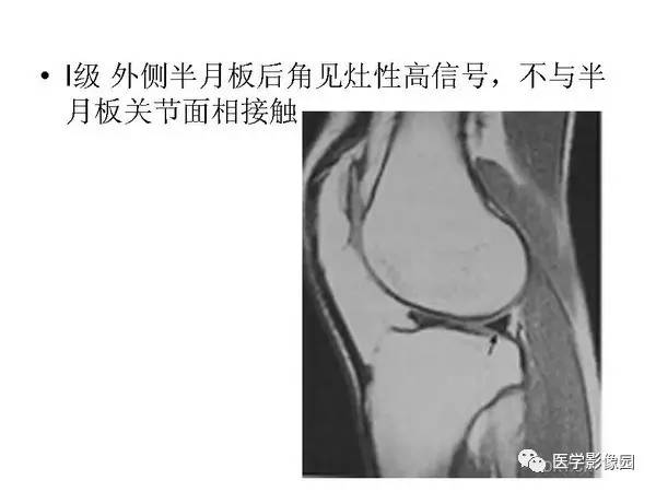 【PPT】半月板的影像学表现