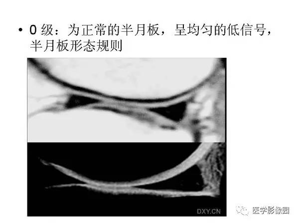【PPT】半月板的影像学表现
