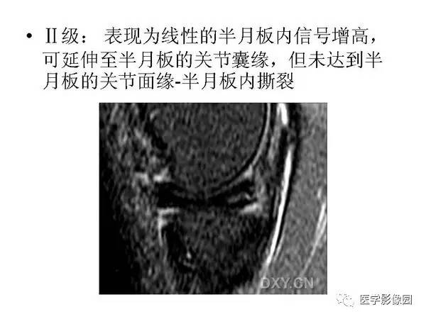【PPT】半月板的影像学表现