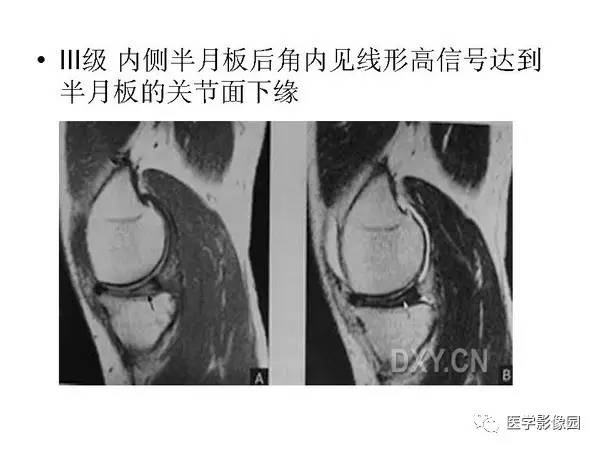 【PPT】半月板的影像学表现