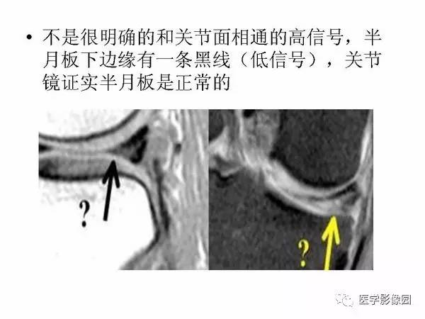 【PPT】半月板的影像学表现