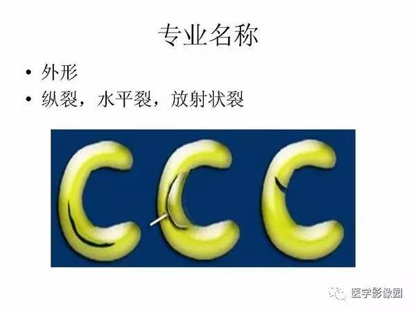 【PPT】半月板的影像学表现