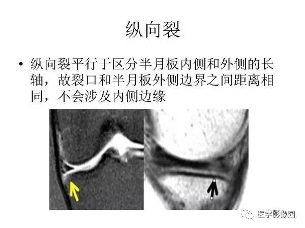 【PPT】半月板的影像学表现