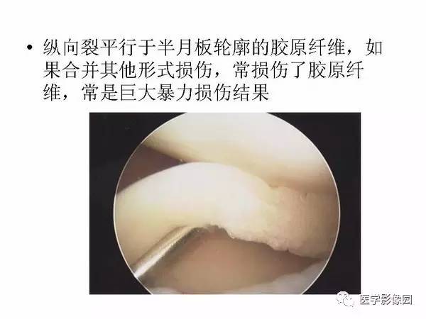 【PPT】半月板的影像学表现