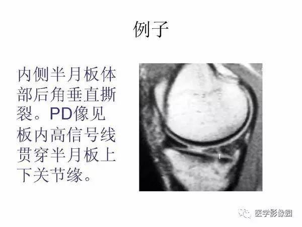 【PPT】半月板的影像学表现