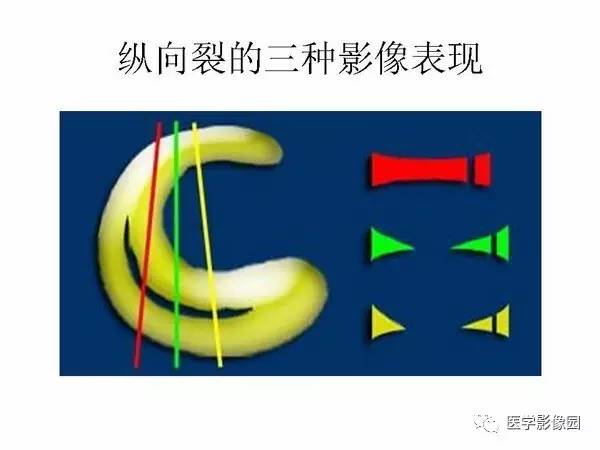 【PPT】半月板的影像学表现