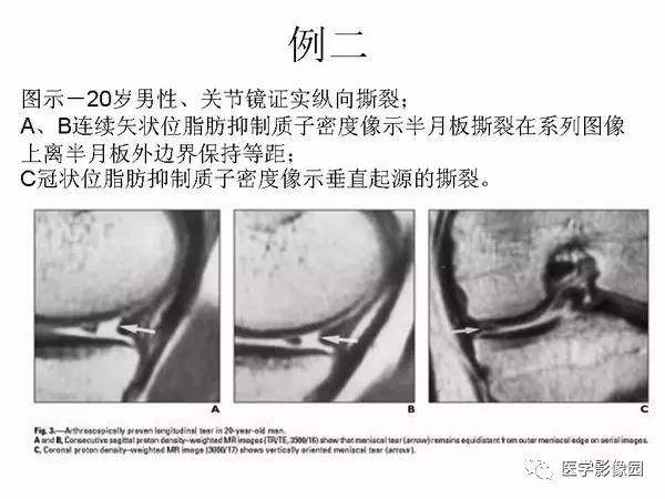 【PPT】半月板的影像学表现