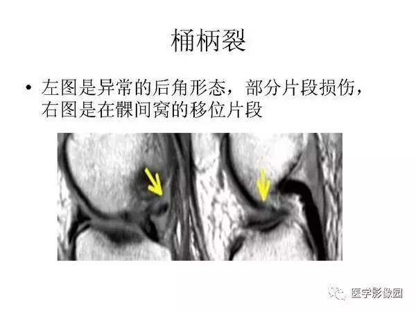 【PPT】半月板的影像学表现