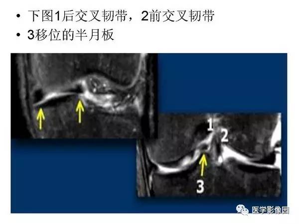 【PPT】半月板的影像学表现