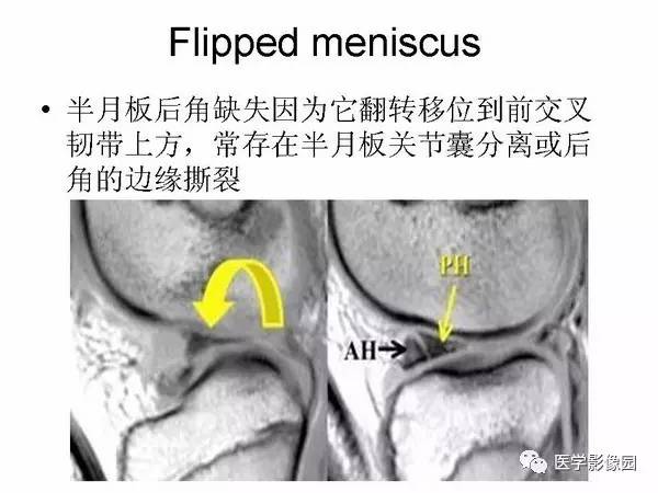 【PPT】半月板的影像学表现