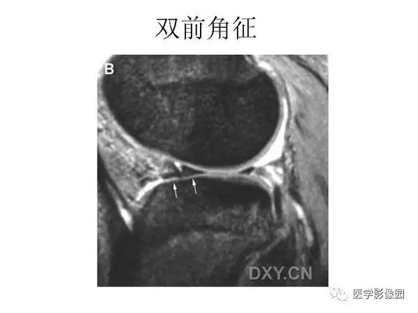 【PPT】半月板的影像学表现
