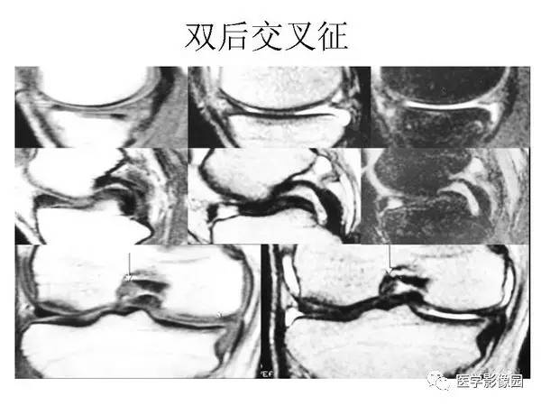 【PPT】半月板的影像学表现