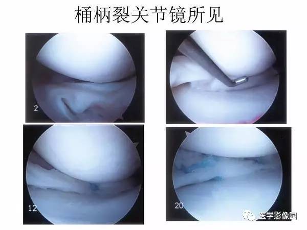 【PPT】半月板的影像学表现