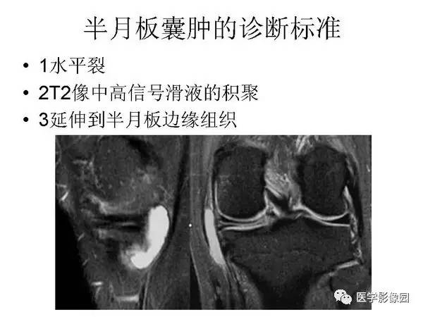 【PPT】半月板的影像学表现