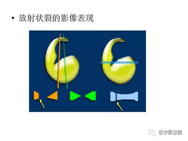 【PPT】半月板的影像学表现