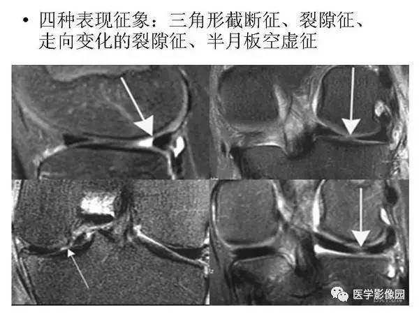 【PPT】半月板的影像学表现