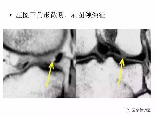 【PPT】半月板的影像学表现