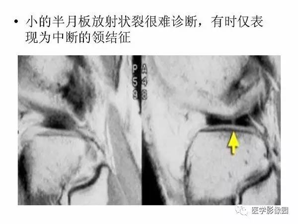 【PPT】半月板的影像学表现