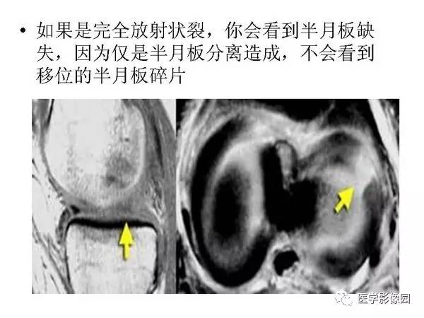 【PPT】半月板的影像学表现