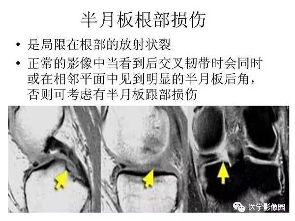 【PPT】半月板的影像学表现