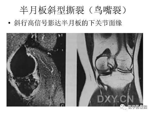 【PPT】半月板的影像学表现