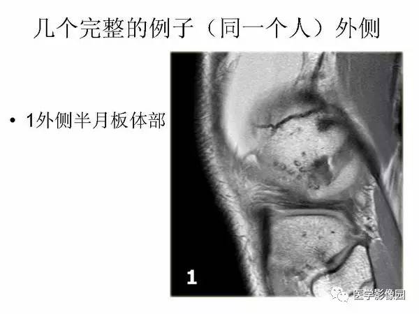 【PPT】半月板的影像学表现