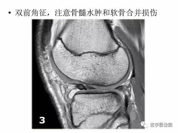 【PPT】半月板的影像学表现