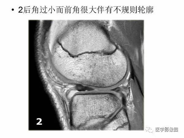 【PPT】半月板的影像学表现