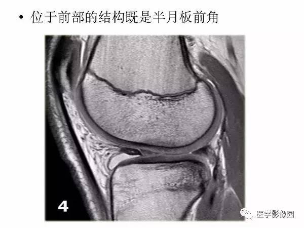 【PPT】半月板的影像学表现