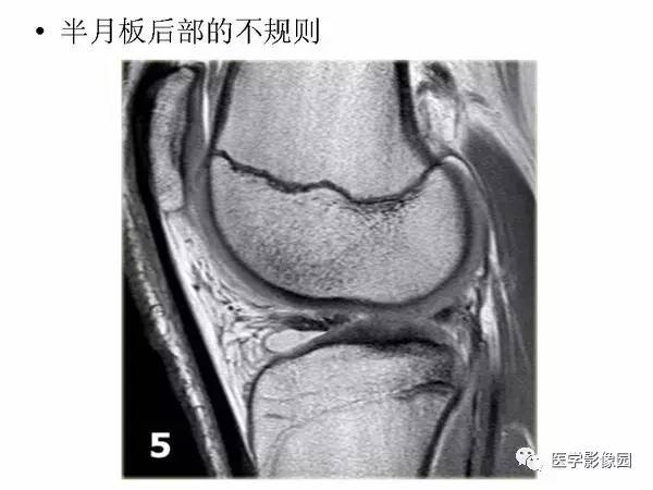 【PPT】半月板的影像学表现