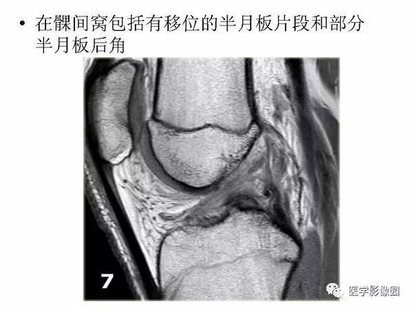 【PPT】半月板的影像学表现