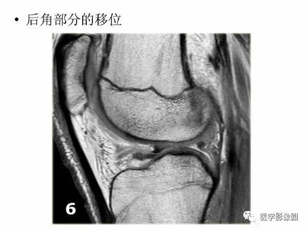 【PPT】半月板的影像学表现