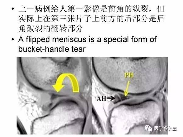 【PPT】半月板的影像学表现