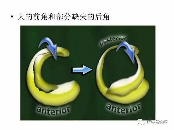 【PPT】半月板的影像学表现