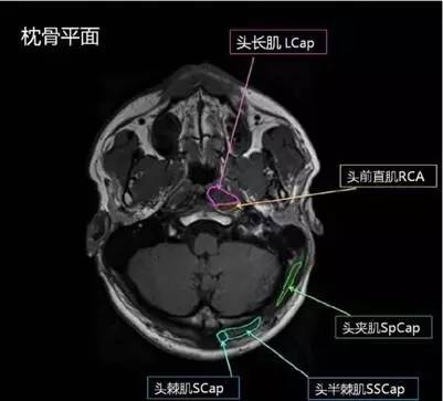 正常颈椎肌肉 MRI 横断位及三维重建图
