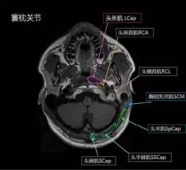 正常颈椎肌肉 MRI 横断位及三维重建图 正常颈椎肌肉 MRI 横断位及三维重建图
