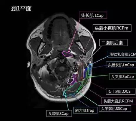 正常颈椎肌肉 MRI 横断位及三维重建图 正常颈椎肌肉 MRI 横断位及三维重建图