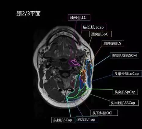 正常颈椎肌肉 MRI 横断位及三维重建图 正常颈椎肌肉 MRI 横断位及三维重建图