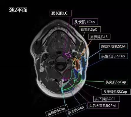 正常颈椎肌肉 MRI 横断位及三维重建图 正常颈椎肌肉 MRI 横断位及三维重建图