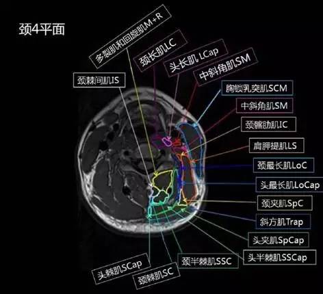 正常颈椎肌肉 MRI 横断位及三维重建图 正常颈椎肌肉 MRI 横断位及三维重建图
