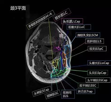 正常颈椎肌肉 MRI 横断位及三维重建图 正常颈椎肌肉 MRI 横断位及三维重建图