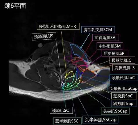 正常颈椎肌肉 MRI 横断位及三维重建图 正常颈椎肌肉 MRI 横断位及三维重建图