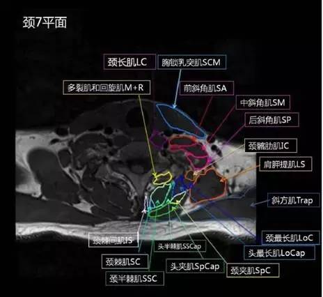 正常颈椎肌肉 MRI 横断位及三维重建图 正常颈椎肌肉 MRI 横断位及三维重建图